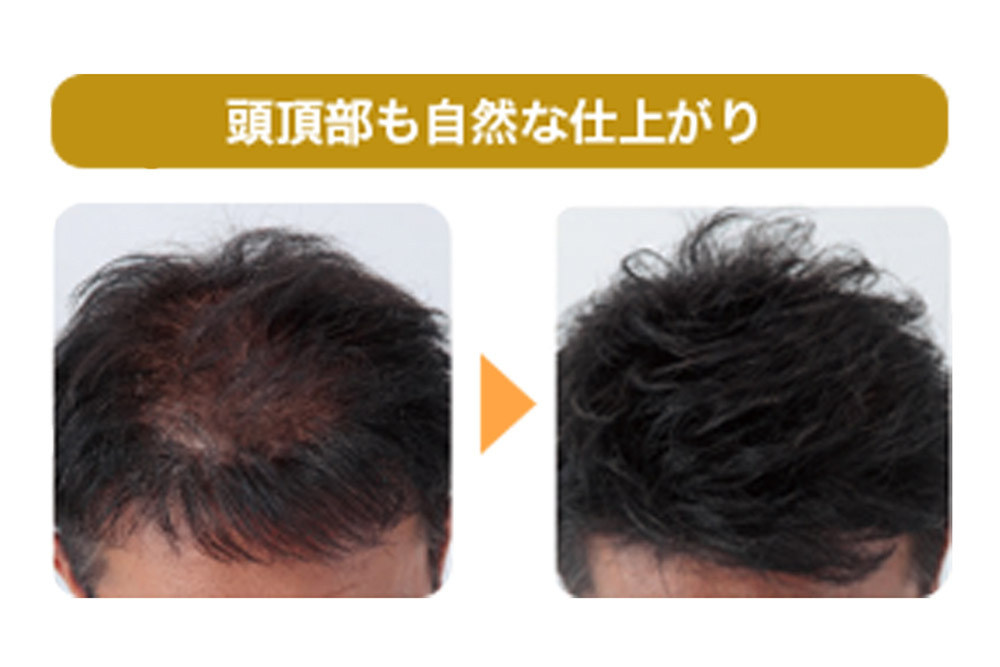 生え際やもみあげに