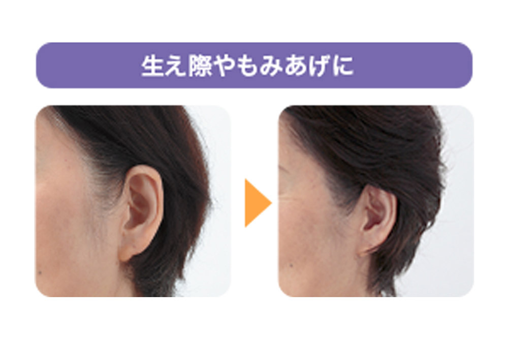 生え際やもみあげに